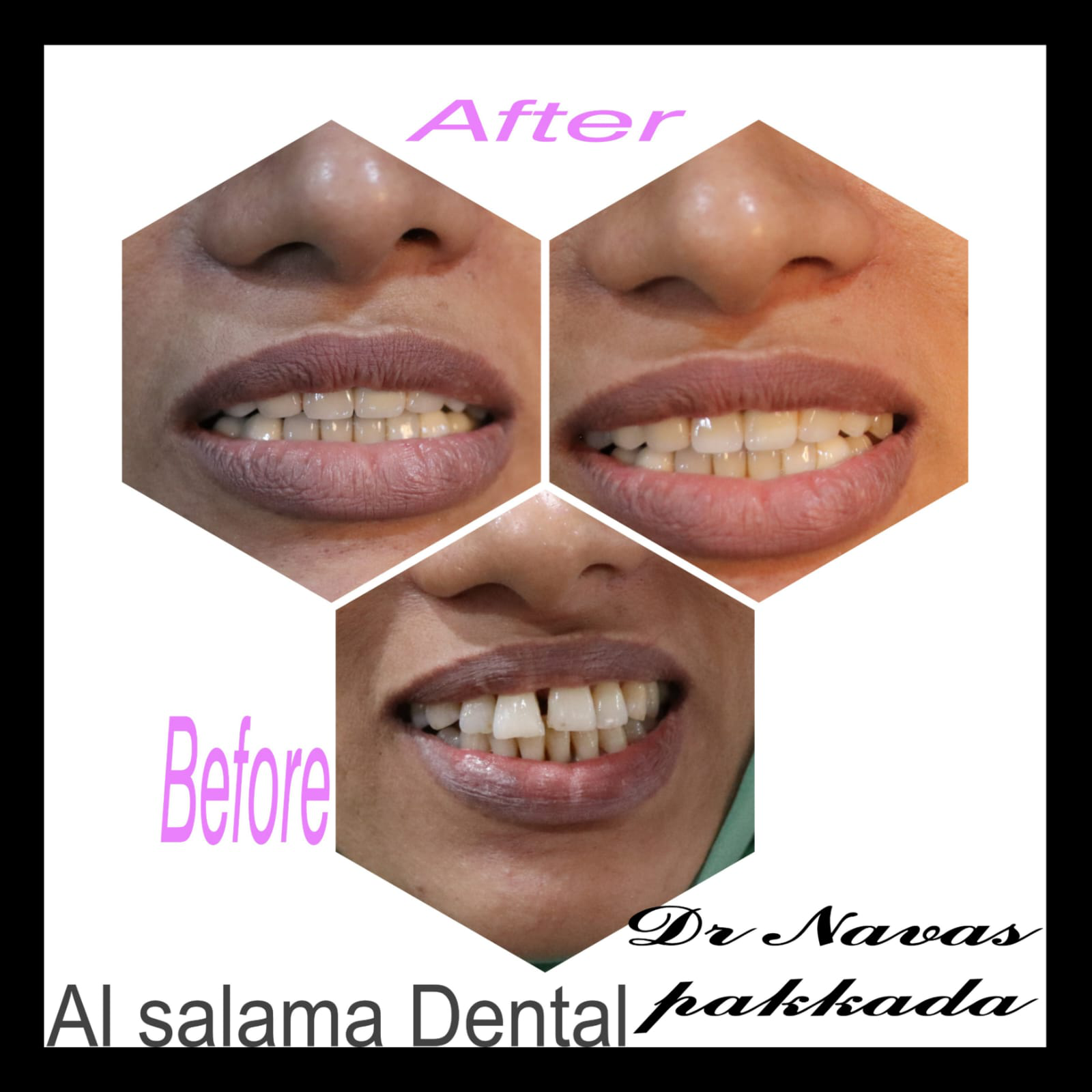 Smile designing
